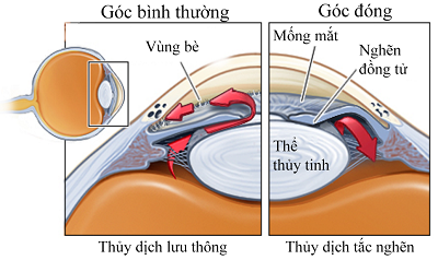 Thuỷ dịch bị 